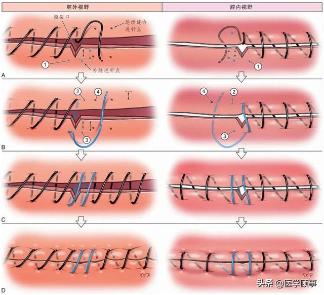 脑血管缝合技巧(下)|动脉粥样硬化_新浪新闻