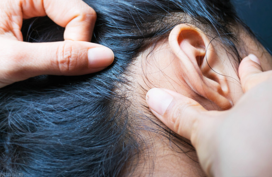 30年前虮子在男女老少人头上很常见为啥忽然间消失不见了