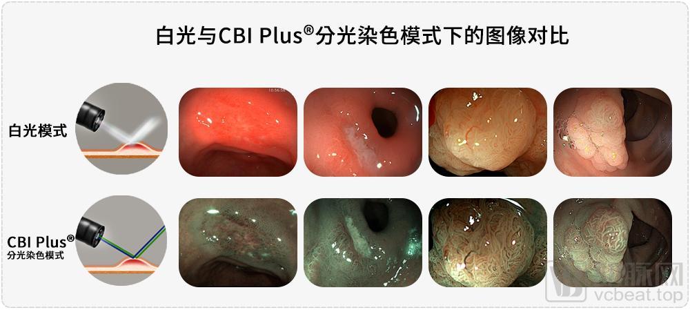 澳华内镜于2013年推出具有分光染色(cbi)功能的电子内镜系统,其具有