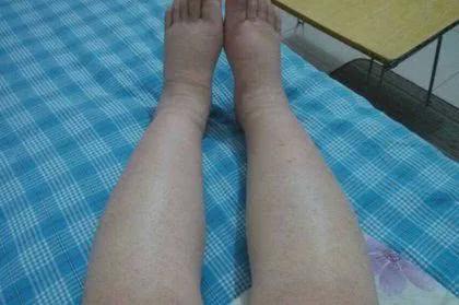 要知道,一旦患上尿毒症之后,全身也会出现浮肿.