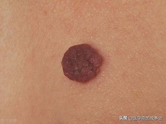 皮肤上长出一个个小肉球是怎么回事可以抠掉吗如何处理
