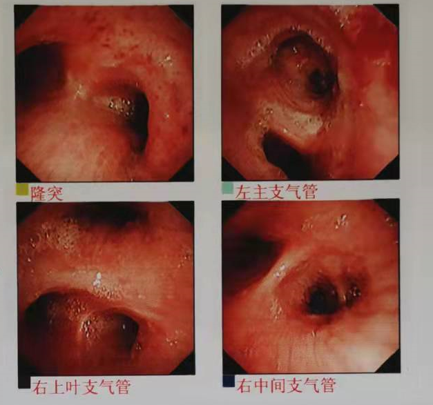 间质性肺炎还是癌性淋巴管炎一招搞定