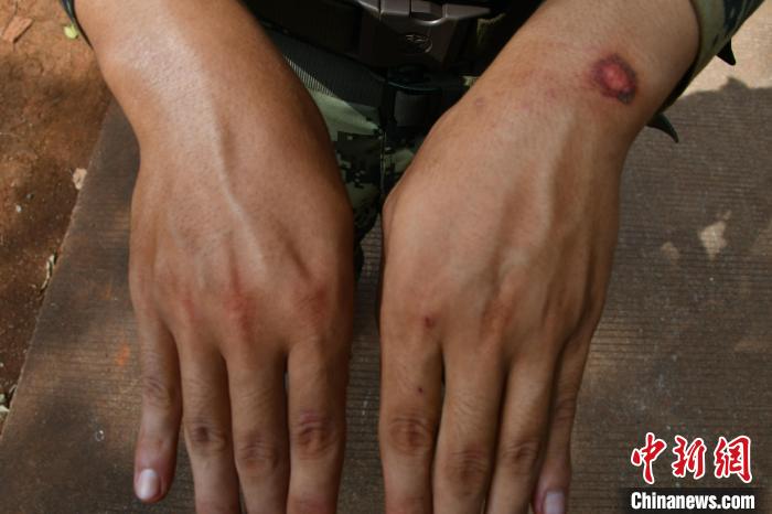 杨亮亮因低姿匍匐爬行导致伤痕. 陈业发 摄