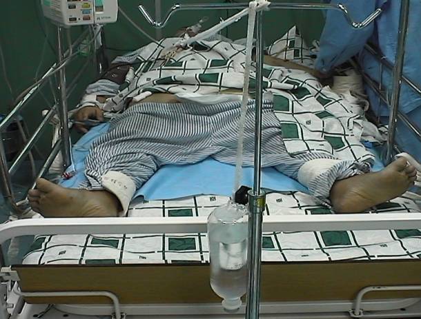 架与鼻尖的成45度角,并悬一500 ml盐水, 注意悬空,再将胃管与负压瓶相