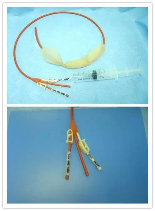 三腔二囊管的临床使用