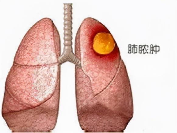 超低价种了颗牙,大叔住进icu!医生提醒:吸入性肺脓肿可致命
