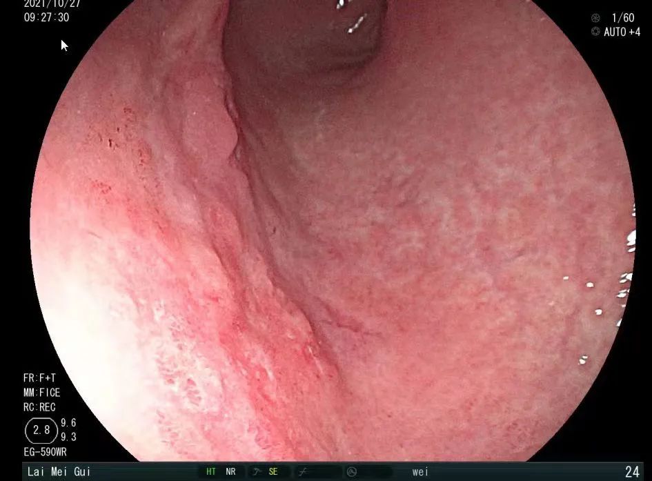 千万注意！厦门一女子长时间双下肢浮肿，一查竟是…休闲区蓝鸢梦想 - Www.slyday.coM