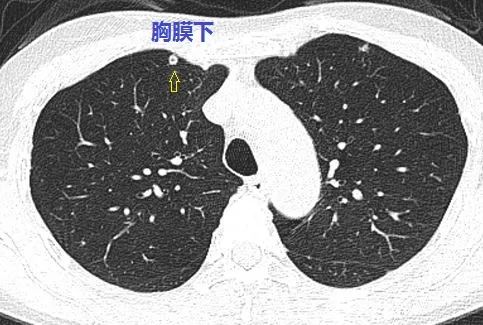 這個與血管相連的雙肺多發小結節,是怎樣的