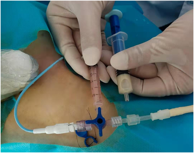 高热!休克!滨医烟台附院导航式服务助高龄肝脓肿患者转危为安