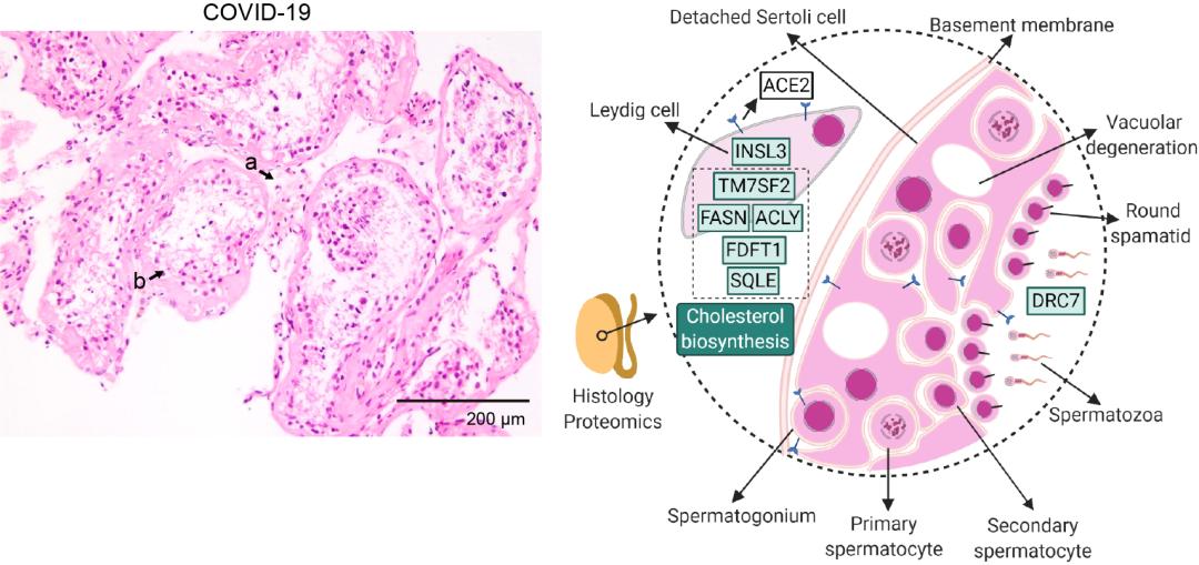 图片说明：新冠肺炎死亡患者睾丸间隙Leydig细胞相对减少，组织内明显下调的蛋白及相关通路示意图。