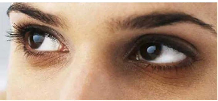 常见的“黑眼圈”分3种，如何选对眼霜有效解决？看这篇就够了休闲区蓝鸢梦想 - Www.slyday.coM