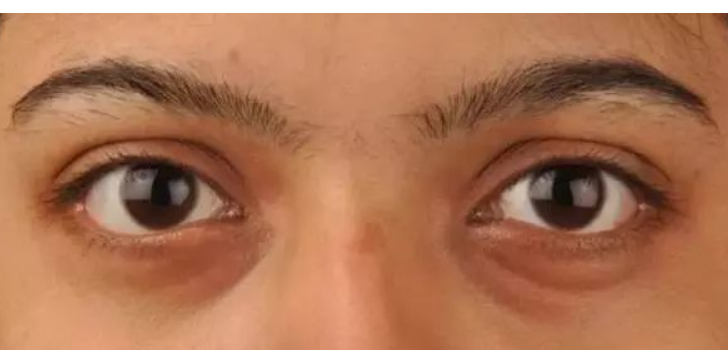 常见的“黑眼圈”分3种，如何选对眼霜有效解决？看这篇就够了休闲区蓝鸢梦想 - Www.slyday.coM