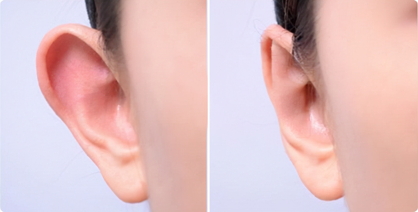 宝宝招风耳6月龄内可无创矫正