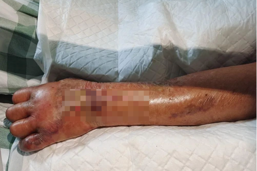 老人洗虾手指被扎没有破皮没有出血最后竟要截肢保命