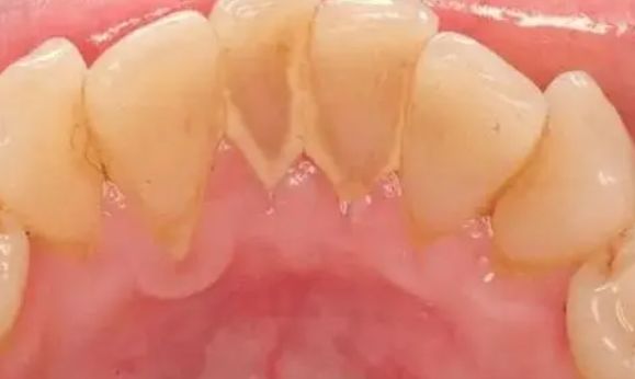 吃东西总是塞牙弄不出来?教你3招轻松解决,牙齿不再有问题休闲区蓝鸢梦想 - Www.slyday.coM 吃东西总是塞牙弄不出来?教你3招轻松解决,牙齿不再有问题休闲区蓝鸢梦想 - Www.slyday.coM