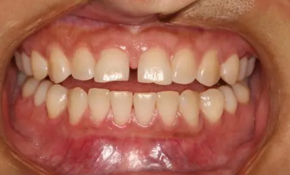 吃东西总是塞牙弄不出来?教你3招轻松解决,牙齿不再有问题休闲区蓝鸢梦想 - Www.slyday.coM 吃东西总是塞牙弄不出来?教你3招轻松解决,牙齿不再有问题休闲区蓝鸢梦想 - Www.slyday.coM