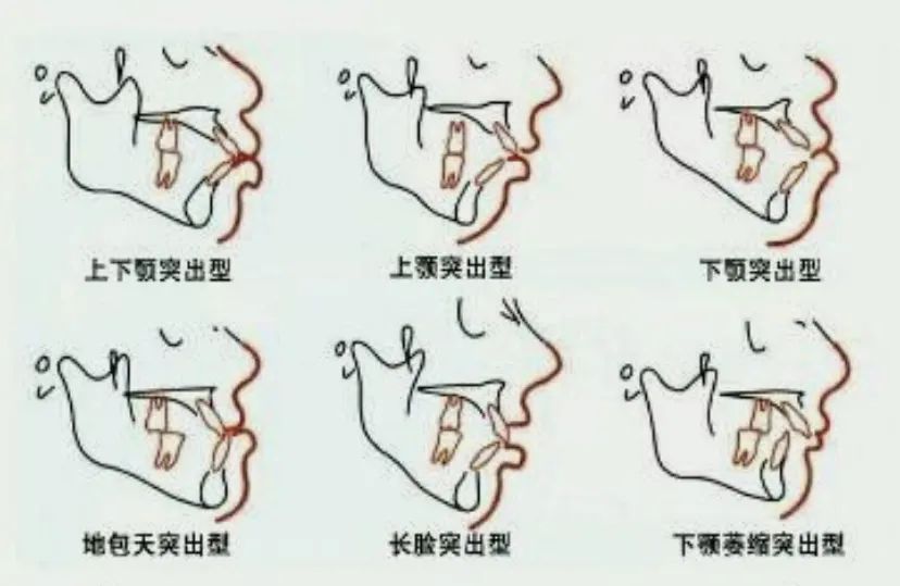 而骨性嘴凸则是因为颌骨发育异常造成的,牙齿没有前倾,但是上下颌发育