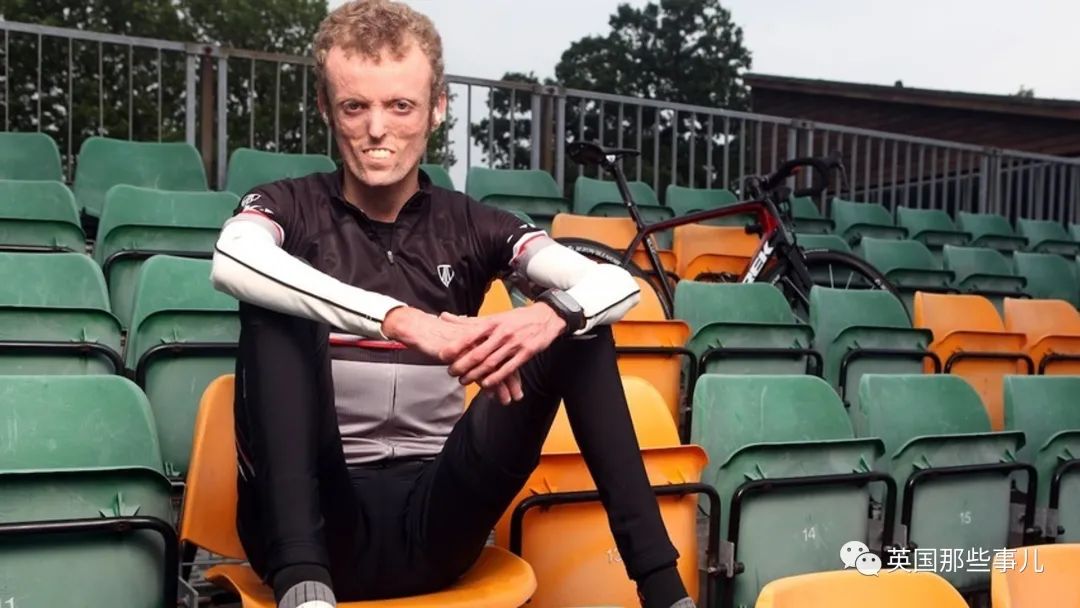 英国少年怎么吃都瘦得像竹竿存不下脂肪竟是患有六亿分之一几率的罕见