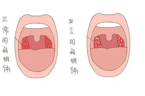 在日常生活中,儿童扁桃体发炎是一种常见的病症,其一年四季均可发病.