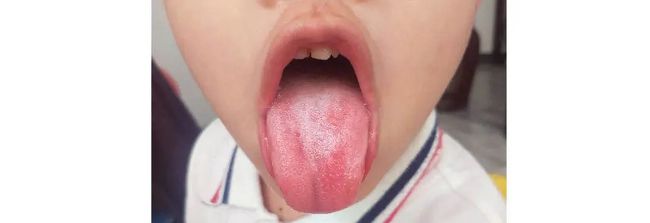 地图舌的原因是什么?如何调理