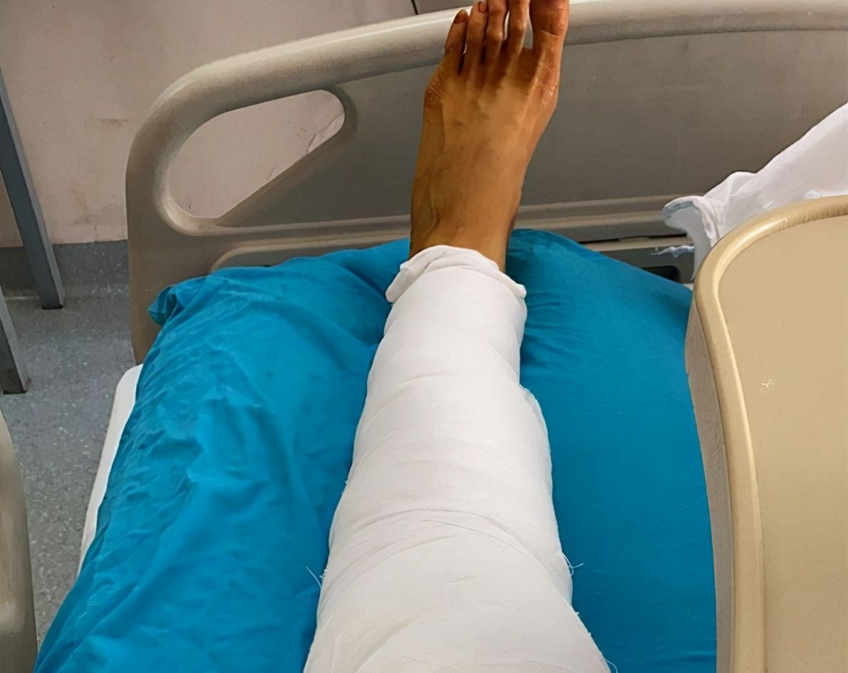 1米95的张常宁腿有多长做膝部手术向球迷报平安病床放不下腿