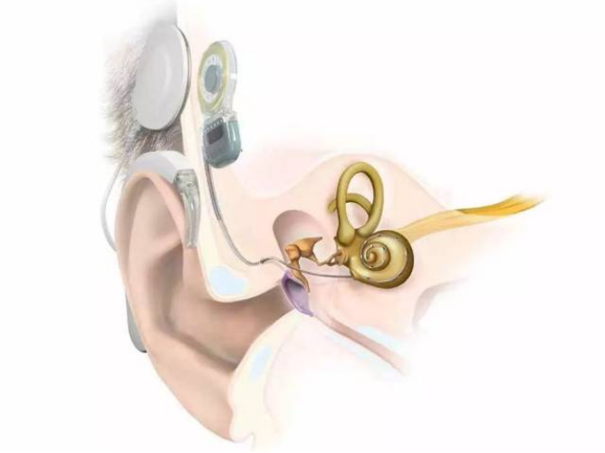得了大前庭导水管综合征就等于是听力为零吗?