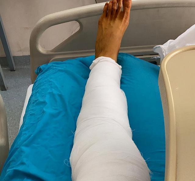 张常宁手术成功后晒照大腿裹满绷带脚趾超长堪比普通人手指