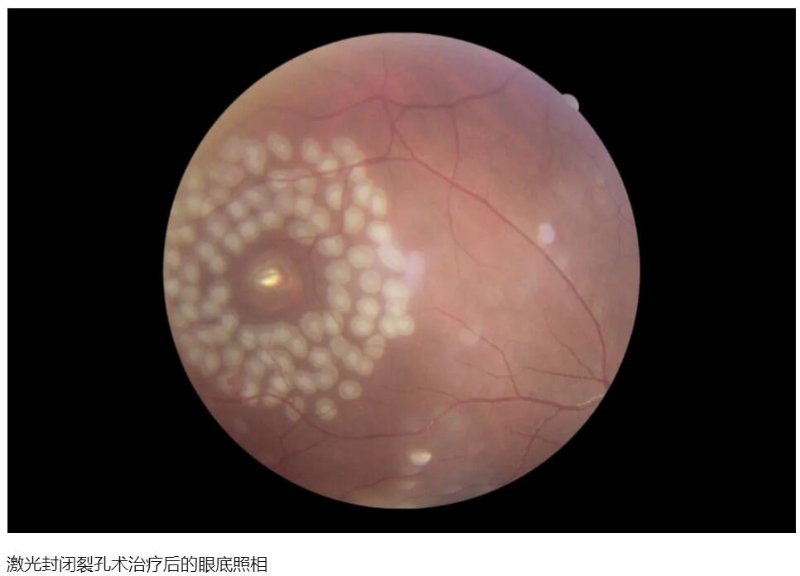 注射器扎入眼球视网膜现裂孔!女医生工作遇险手术恢复