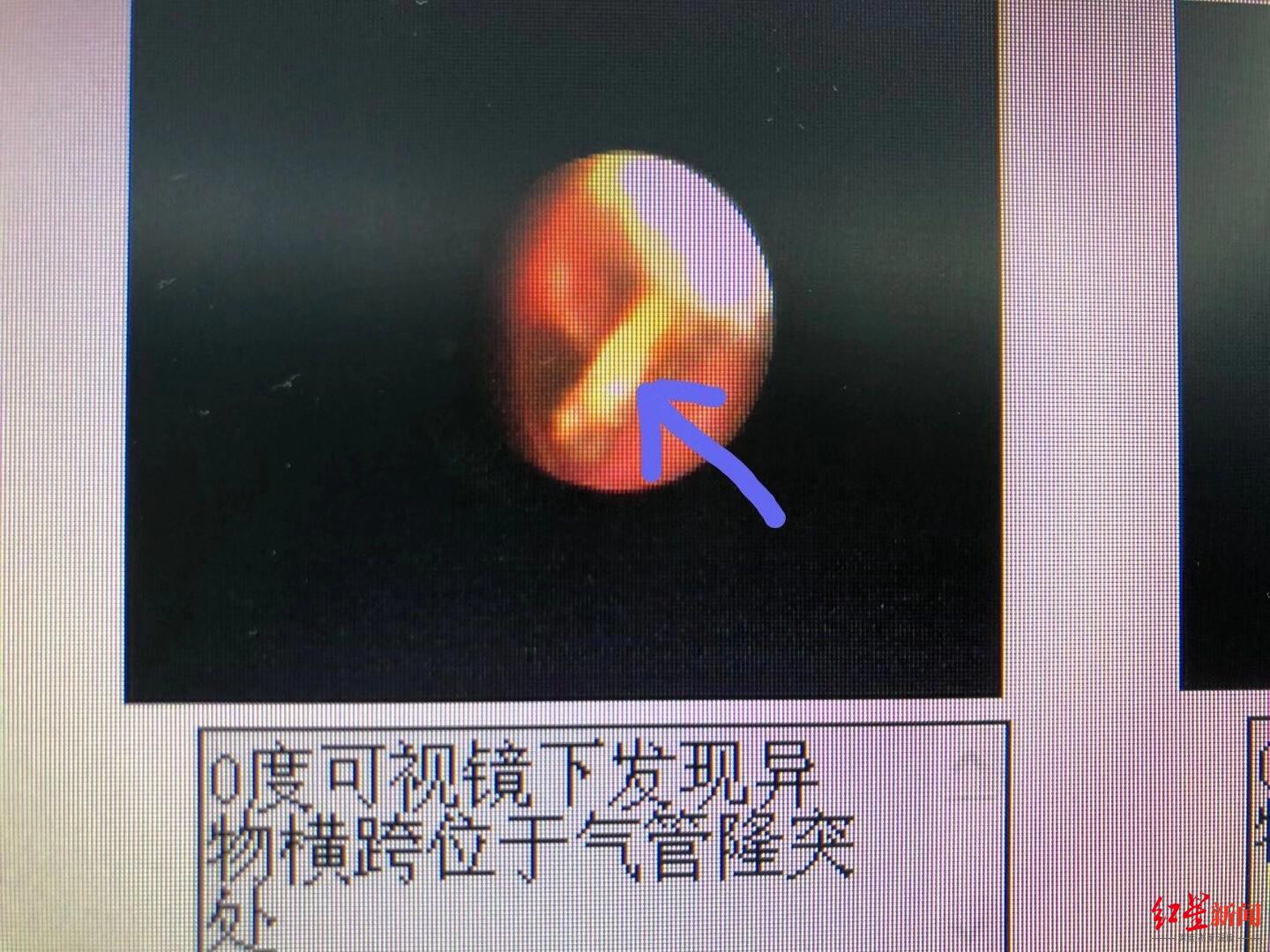 半月收治6例气管异物 医生:要过年了,儿童异物误吸高发,家长须警惕|外科_新浪新闻