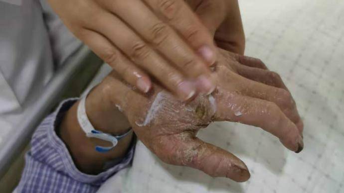 济南这"两双手"火了:看见农民工手皲裂,护士为他涂护手霜