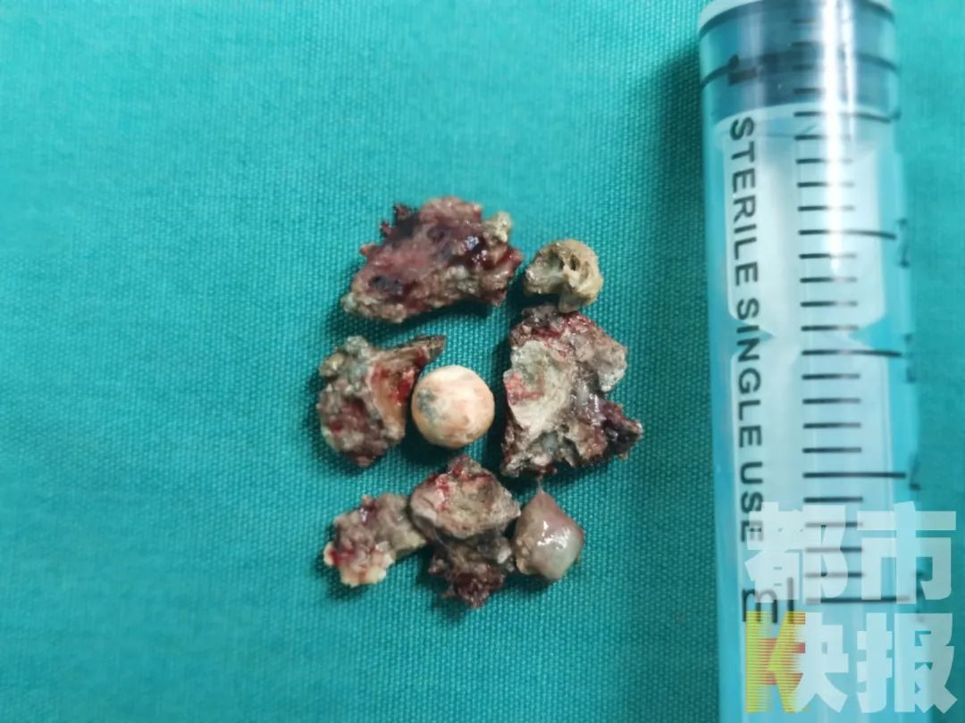 而取出了结石,切除腺样体后,女孩终于有了清爽通气的正常鼻腔