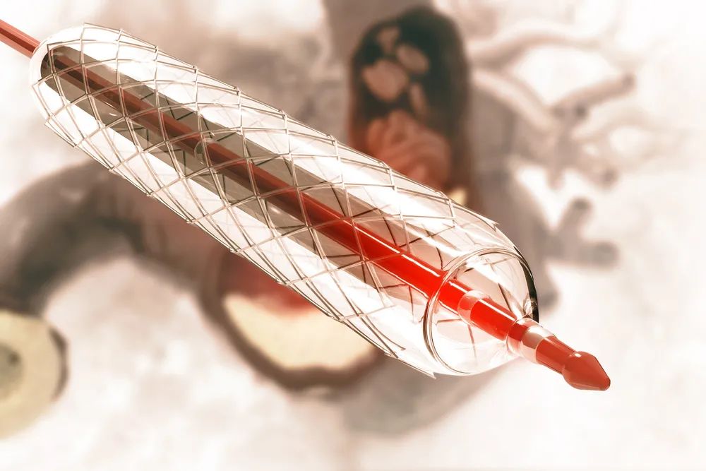 3万降至700元的心脏支架,落地了!超100万患者受益