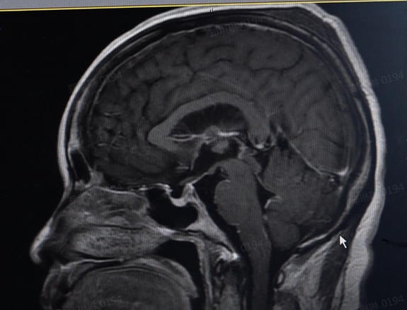 警惕！女子高烧42℃住进ICU，只因吃了这个剩饭？休闲区蓝鸢梦想 - Www.slyday.coM