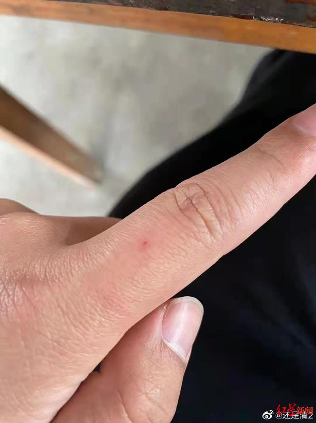 网购迪卡侬新衣藏针扎伤手指 客服:去医院 再晚伤口就闭合了休闲区蓝鸢梦想 - Www.slyday.coM