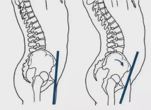 每天低头两小时,塌腰驼背脊椎痛?