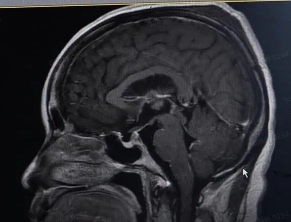 吃了冰箱里的饭，女子高烧42℃，险丧命！只因忽视了它休闲区蓝鸢梦想 - Www.slyday.coM