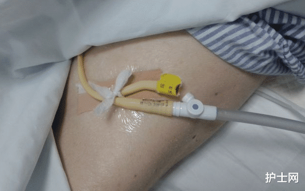 患者尿管自行脱出只因这件事做的不对