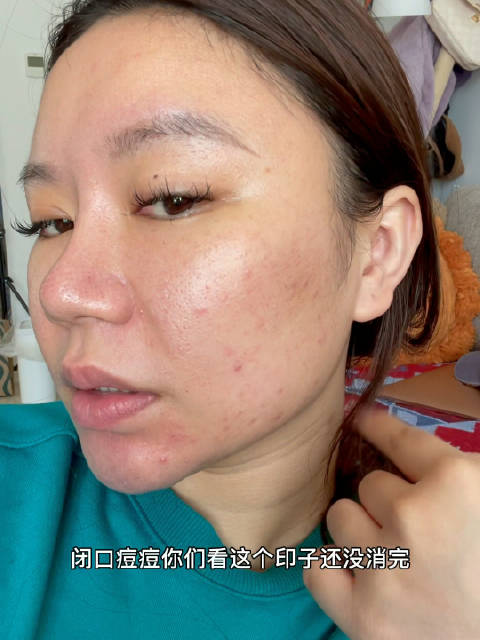 谨点黄金微针恢复的第三天果不其然长了好多小白脓