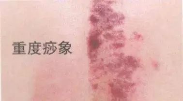 刮痧后的痧印分析，刮痧印反映了不同的健康状况！