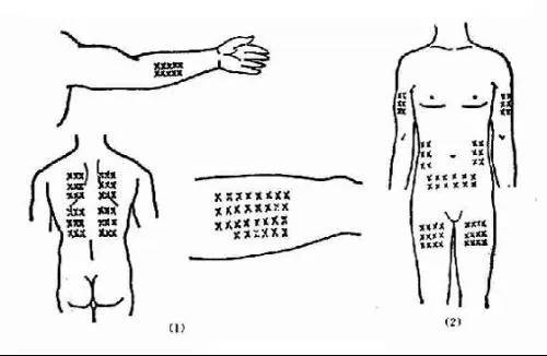 上臂三角肌下缘,上臂外侧,腹部,后背及大腿外侧方(图2).二,部位3.