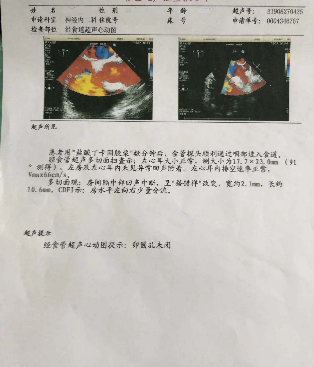 42岁的王先生发生脑梗后,超声心动图检查结果提示"卵圆孔未闭可能"