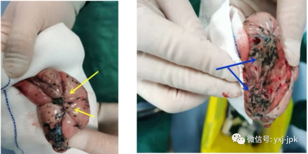 肺结节混合磨玻璃影究竟要不要手术一文解读