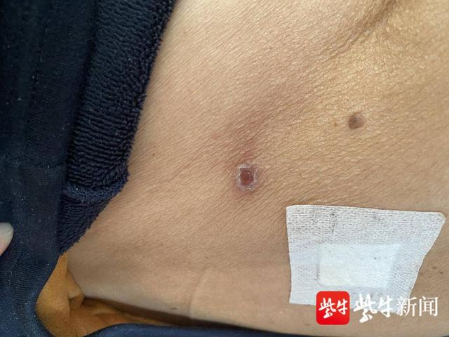 菜地收菜后高烧一周,身体出现黑色"焦痂"|恙虫病|焦痂|陈念_新浪新闻