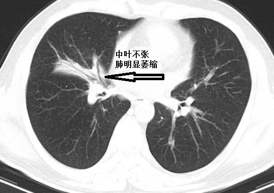 肺不张ct读片太难看完这篇文章轻松入门