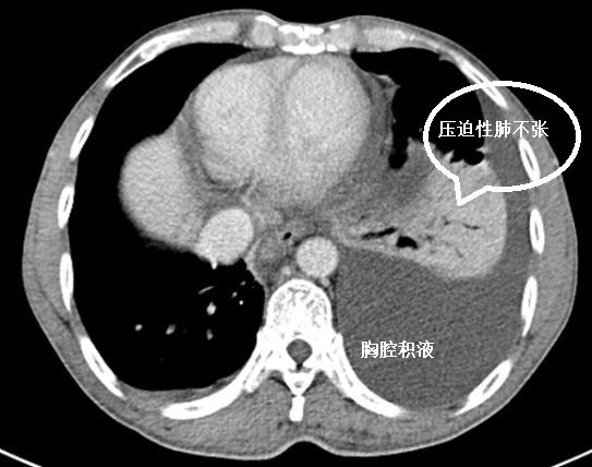 肺不张ct读片太难看完这篇文章轻松入门