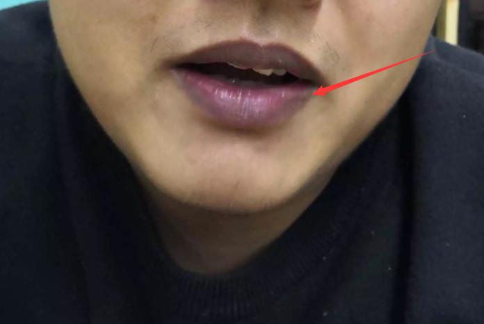 当肝脏受损时,嘴唇会呈现深紫色.