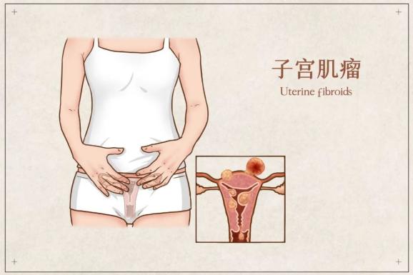 子宫肌瘤 瘤 住的可不是你的青春 手机新浪网