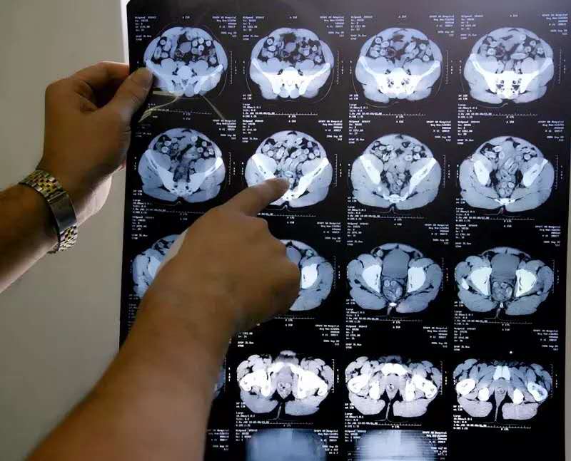 CT片显示毒品走私嫌疑人体内所藏的毒丸。海关总署 图