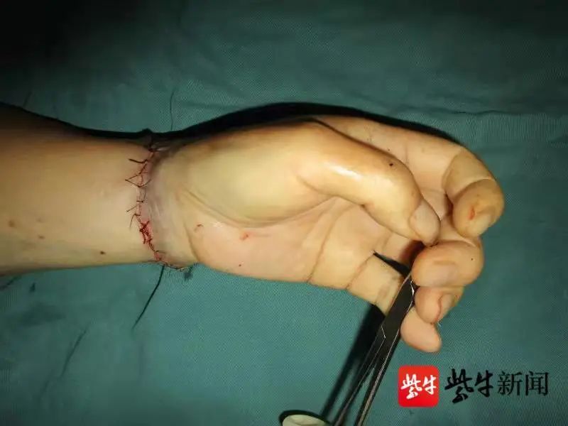 老人在家忽然自残剁掉自己左手