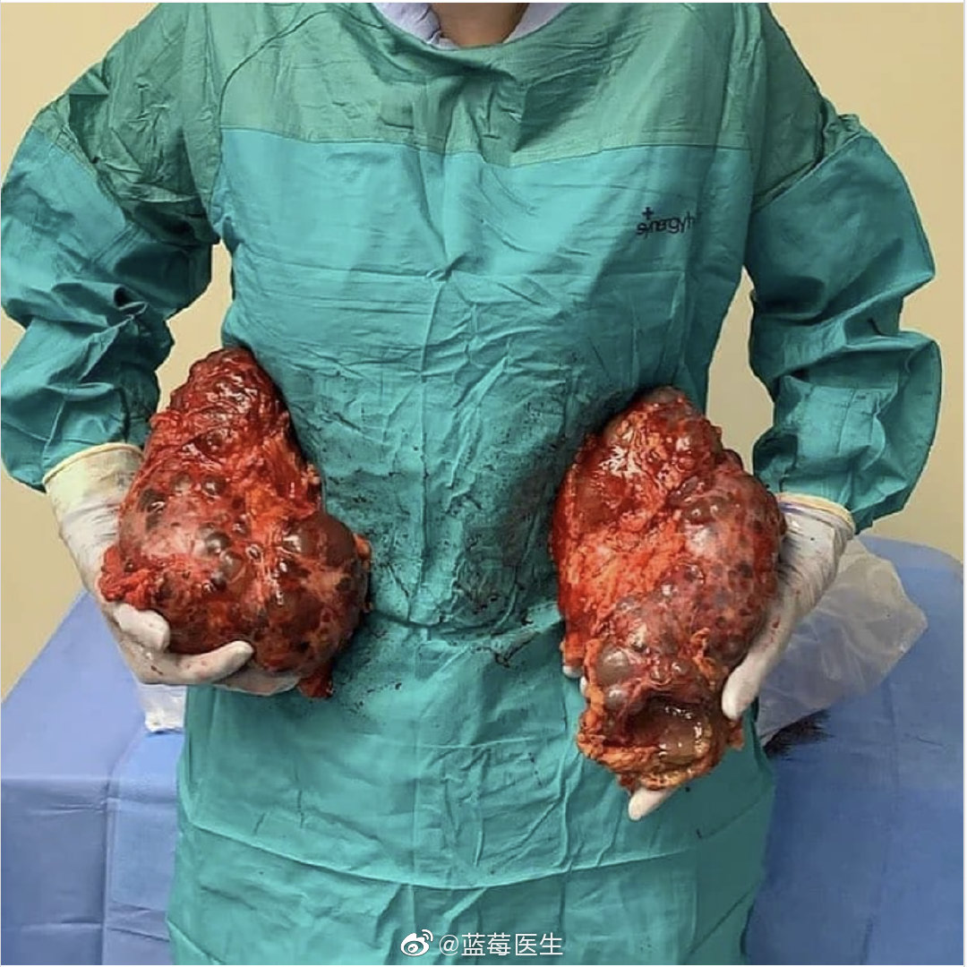 常染色体显性遗传性多囊肾(adpkd)切除术后为肾移植做准备